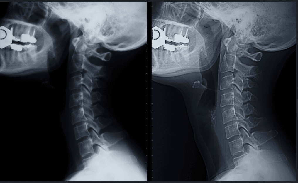 Comparing cervical disc replacement vs spinal fusion surgery options for neck pain, with expert care from Saville Spine Institute in Palm Beach Gardens.