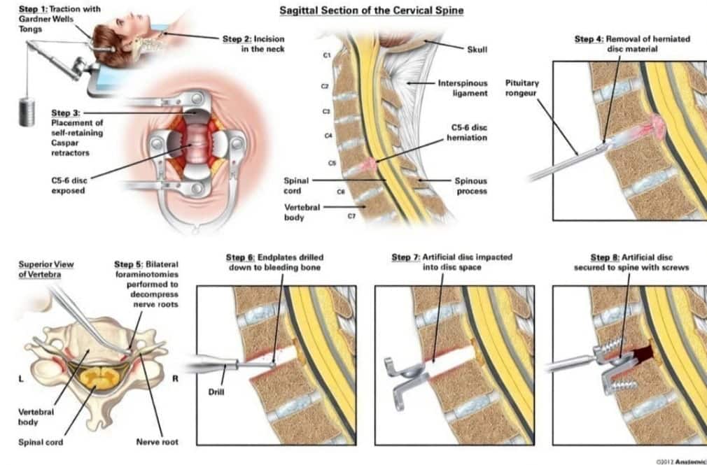 Cervical Disc Replacement: Keeping Motion