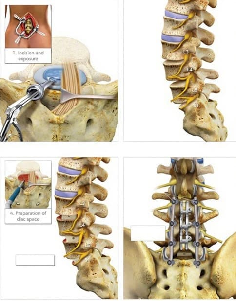 Cervical Disc Replacement: Keeping Motion