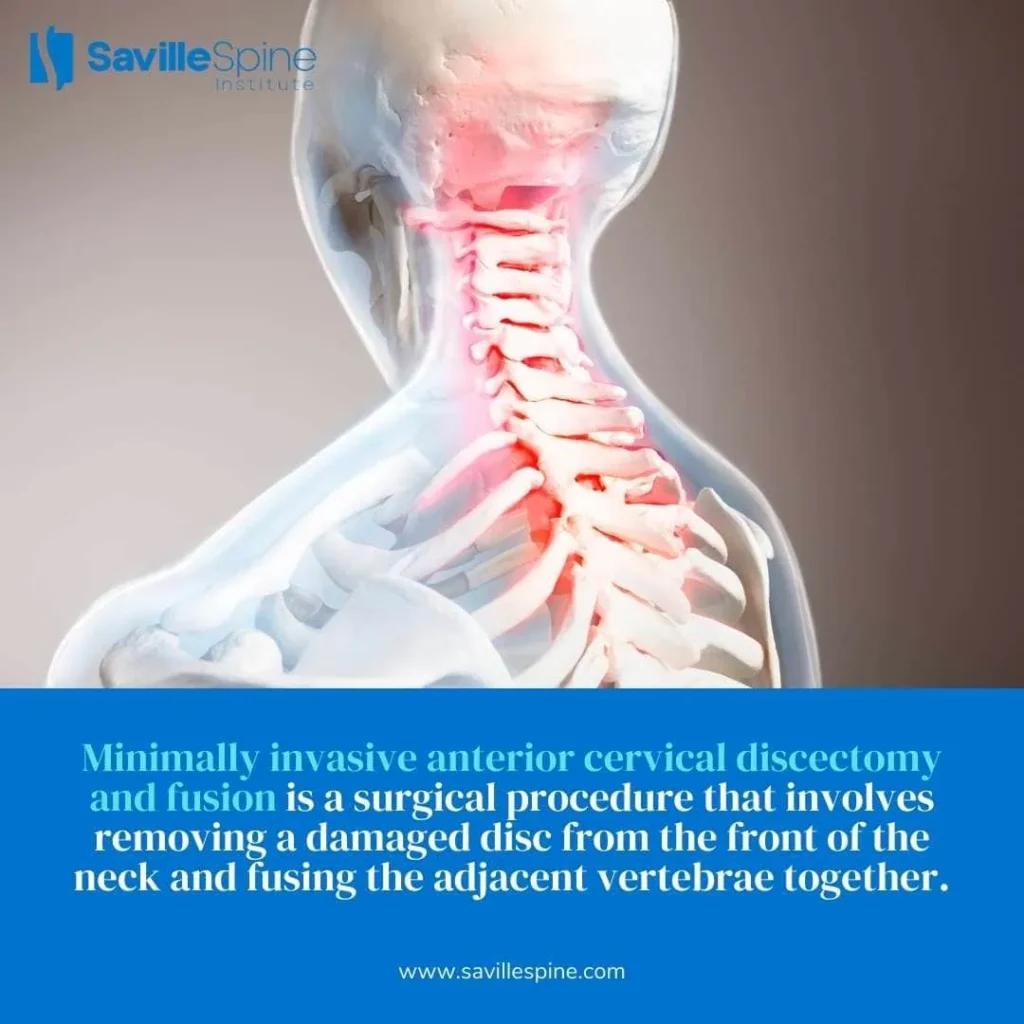 Minimally-Invasive-Anterior-Cervical-Discectomy-and-Fusion-ACDF-A-1