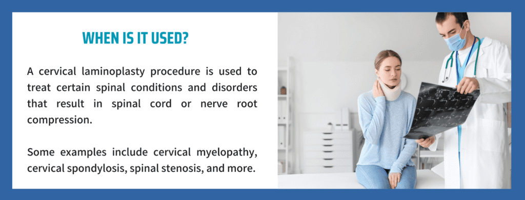 FAQs on Cervical Laminoplasty