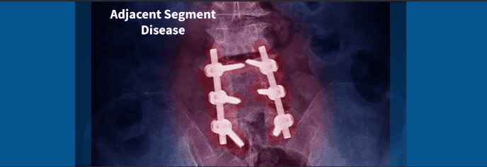 Avoiding Adjacent Segment Disease: The Advantage of Arthroplasty Over Fusion