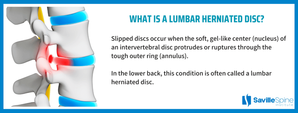 Lower Back Slipped Discs: Causes, Symptoms, and Solutions